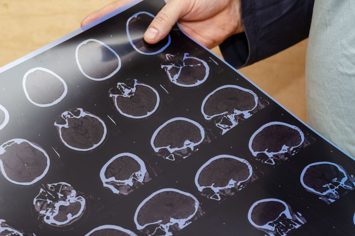 Appleton Traumatic Brain Injury Lawyer